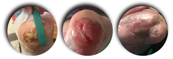 POST OPERATIVE DIABETIC/PRESSURE ULCERS