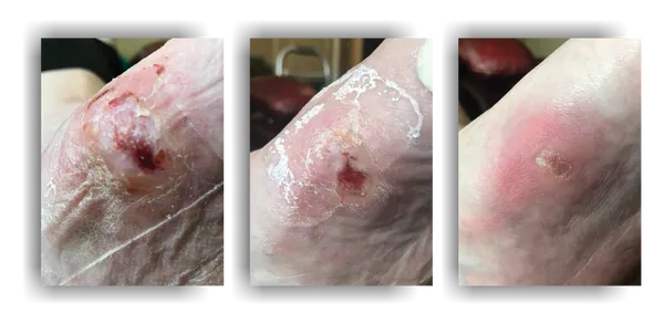 POST OPERATIVE DIABETIC/PRESSURE ULCERS