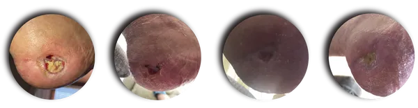 PRESSURE ULCER/ARTERIAL INSUFFICIENCY