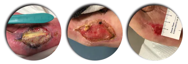 TRAUMATIC/VENOUS STASIS