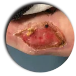 Wound Care